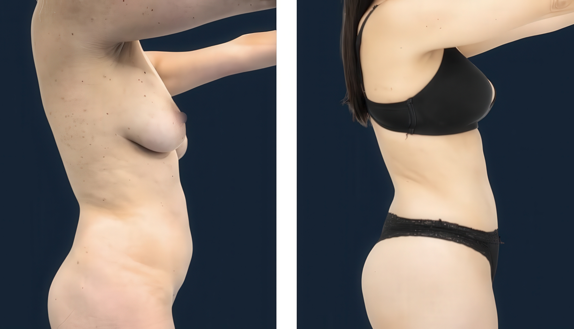 Antes y después de lipoabdominoplastía