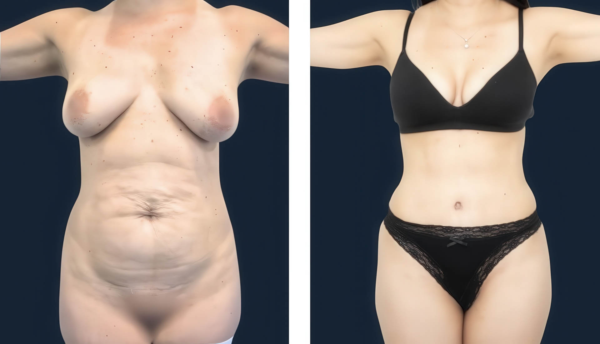 Antes y después de lipoabdominoplastía - vista 2