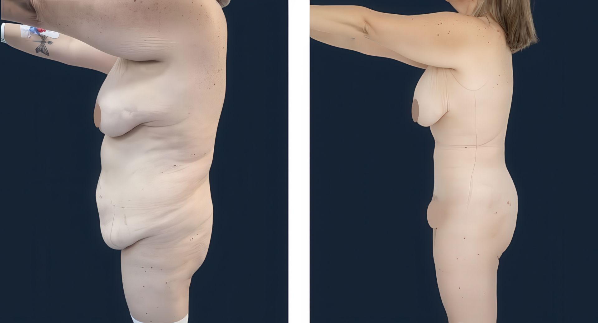 Antes y después de lipoabdominoplastía Flor de Lis