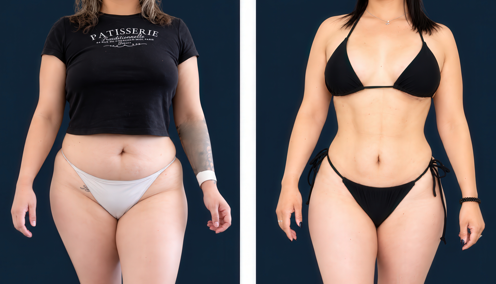 Antes y después de mastopexia con miniabdominoplastía