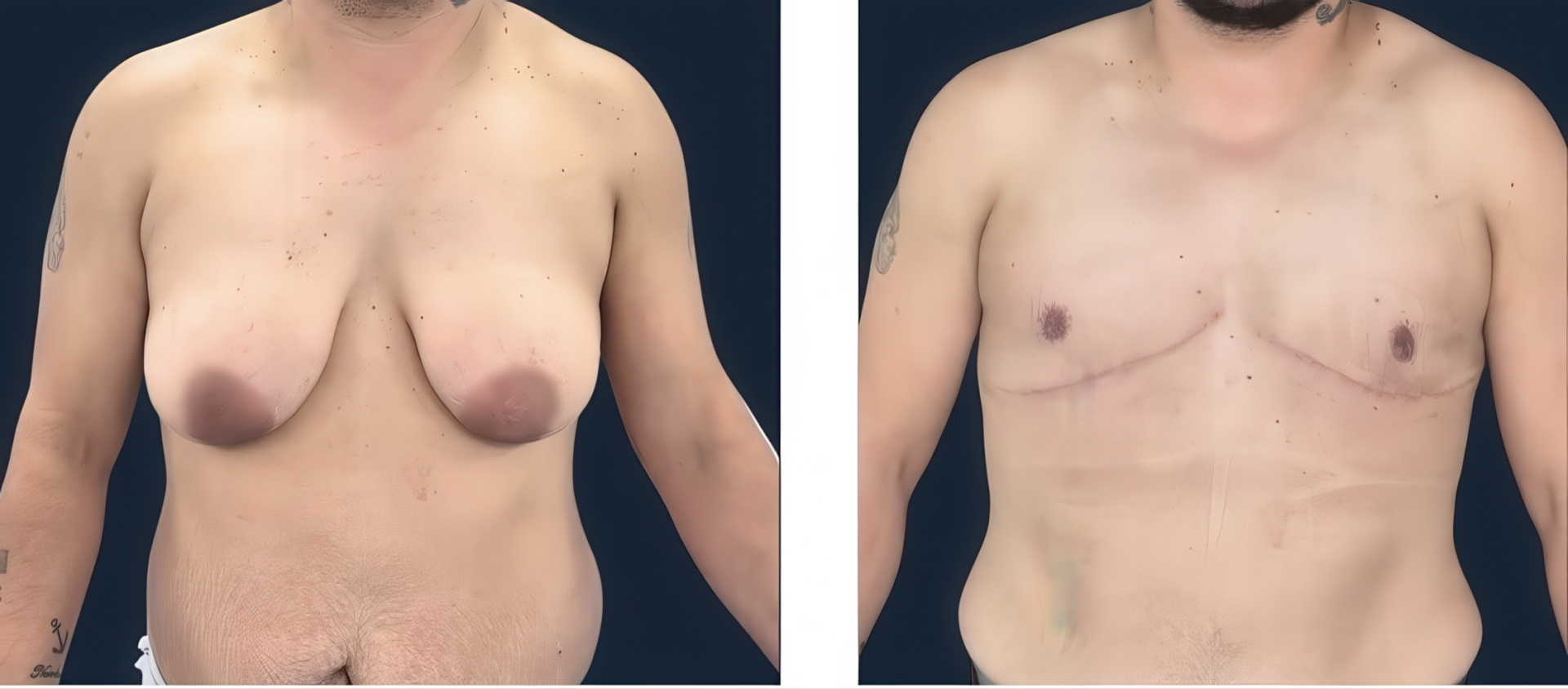 Antes y después de reasignación de sexo