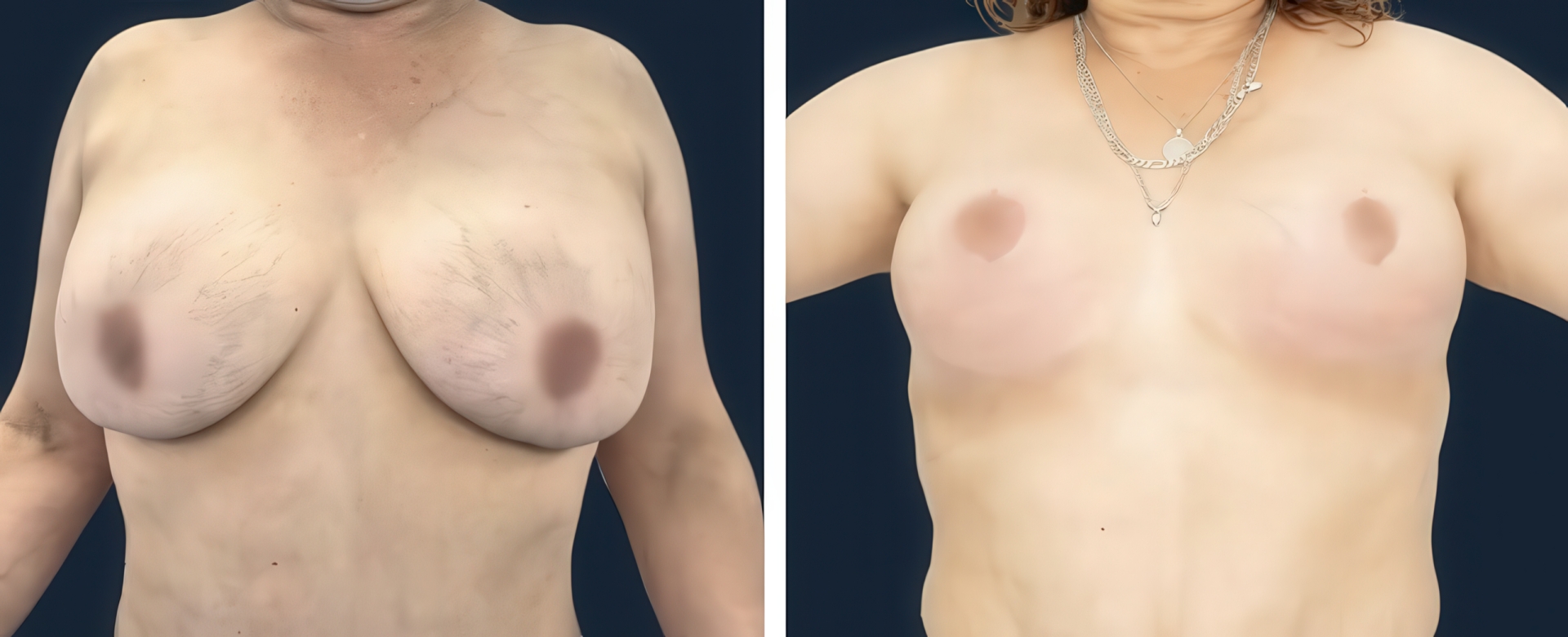 Antes y después de reducción mamaria - vista 2